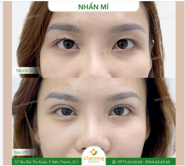 Nhấn mí có thể giúp bạn thay đổi nhẹ nhàng nhưng lại mang đến sức hút vô cùng cho đôi mắt đó nha