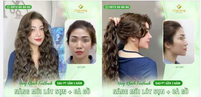 Đây là hình ảnh nàng khách sau gần 3 năm thực hiện nâng mũi lót sụn kết hợp cà gồ mũi - dáng mũi vẫn thon gọn, hài hòa, và tự nhiên như ngày đầu.