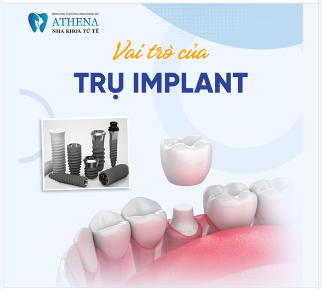Vai trò của trụ implant trong phục hồi mất răng 