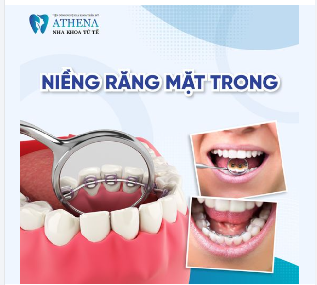 Ưu Điểm Nổi Bật Của Niềng Răng Mặt Lưỡi: