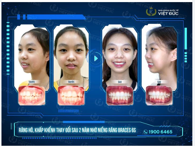 NIỀNG RĂNG BÁC SĨ MẬU ĐÃ GIÚP TÔI THAY ĐỔI NHƯ THẾ NÀO?
