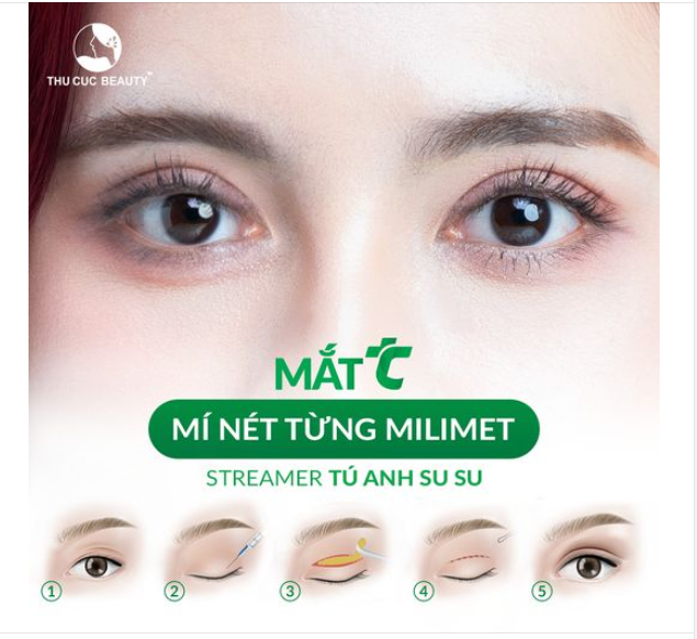 Chớp ngay khuyến mại cực sốc cắt mí tại TC