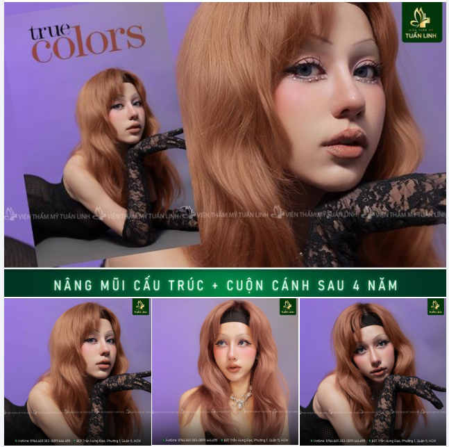 Nâng mũi cấu trúc Sale còn 30Triệu ( gốc 35 triệu) TẶNG bọc Megaderm!!