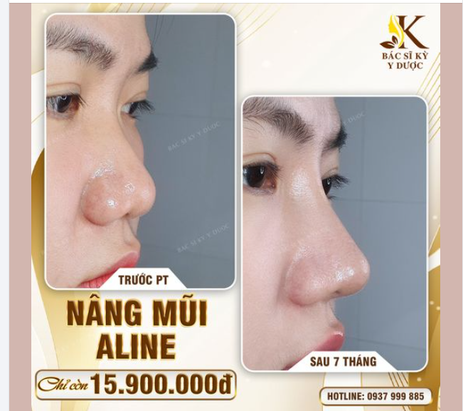 ƯU ĐÃI CỰC SỐC - NÂNG MŨI ALINE CHỈ 15.9TR