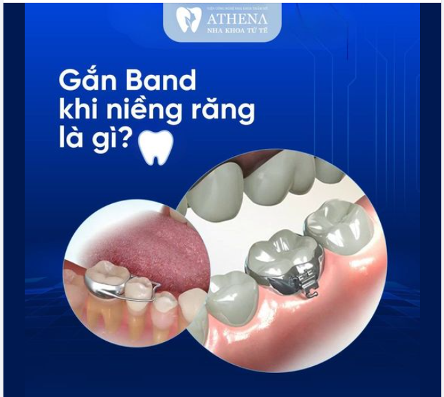 Gắn band khi niềng răng là một quy trình trong quá trình chỉnh nha, đặc biệt là khi sử dụng phương pháp niềng răng mắc cài.
