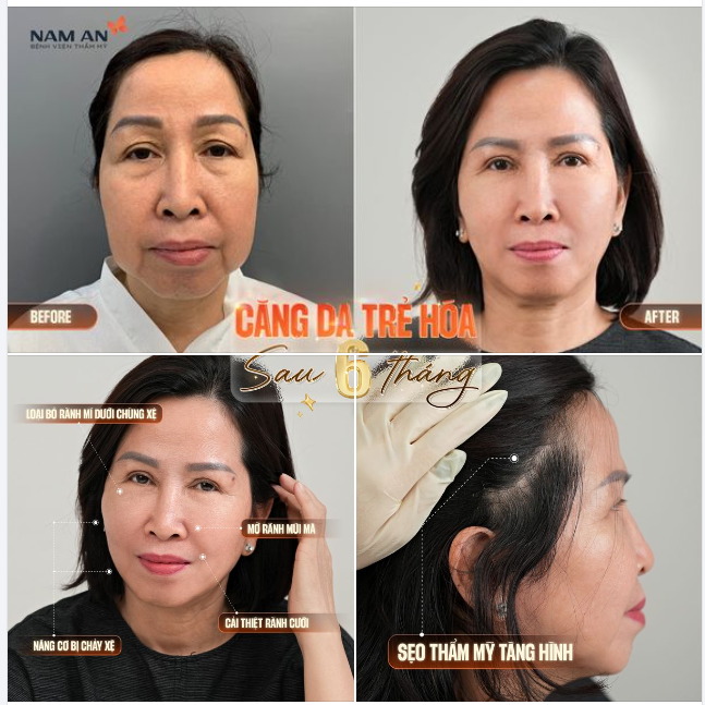 TRẺ TRUNG, TƯƠI MỚI VỚI DỊCH VỤ CĂNG DA MẶT TẠI NAM AN
