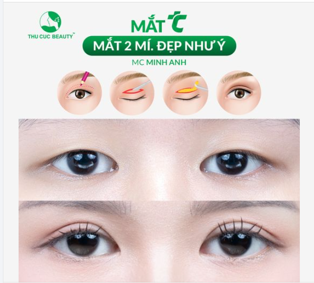 Mắt 1 mí hóa 2 mí cân đều, sắc nét Chọn Cắt mí TC