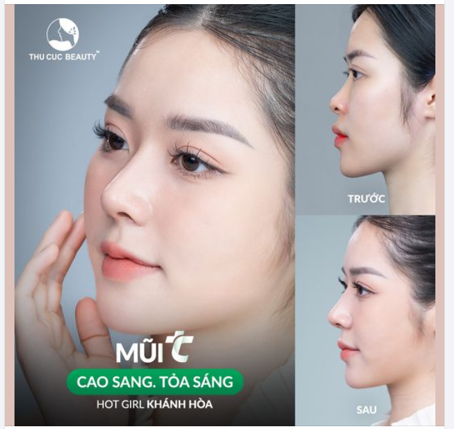 Xóa sổ sống mũi tẹt  Hotgirl Khánh Hòa tự tin với diện mạo mới