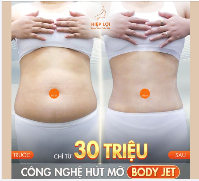 Hình ảnh thực tế trước/sau của khách sau trải nghiệm "Công nghệ Hút mỡ Body Jet"