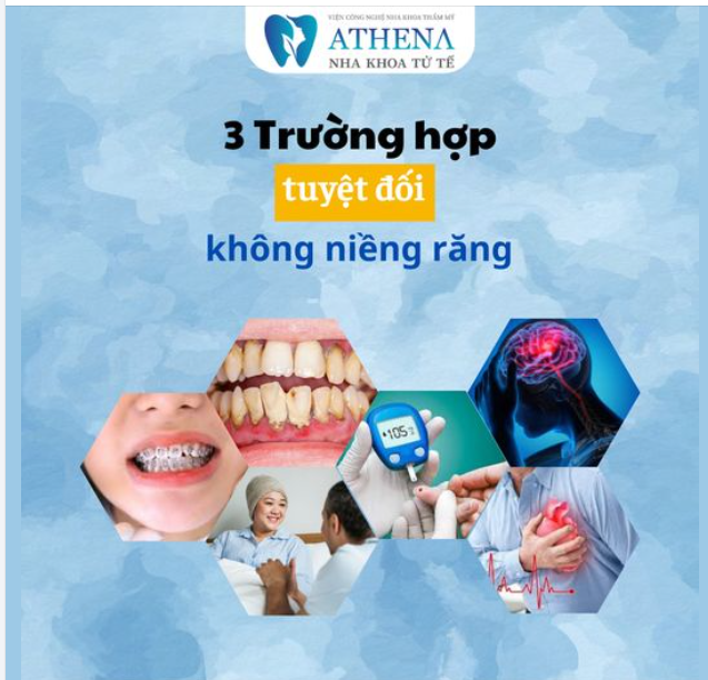 Để có 1 nụ cười đẹp, hàm răng đều thẳng tắp, an nhai tốt, ít gặp bệnh lý răng miệng thì niềng răng là phương pháp chỉnh nha được áp dụng khá phổ biến hiện nay.