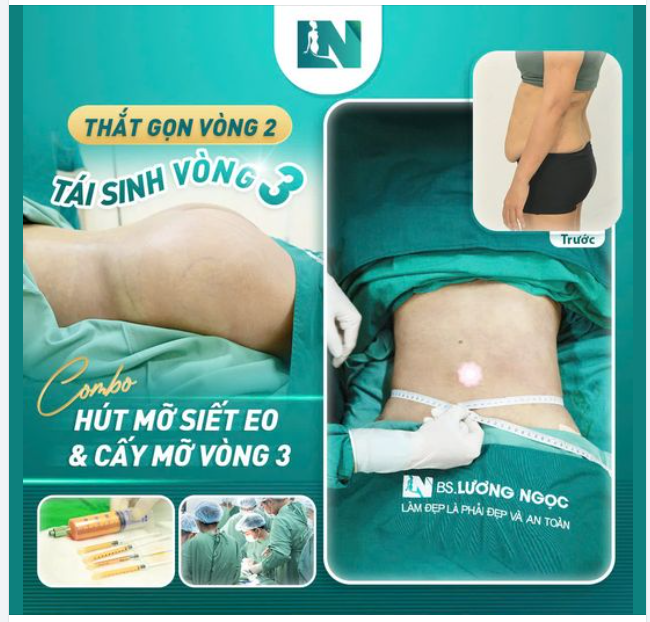 COMBO HÚT MỠ SIẾT EO CẤY MỠ VÒNG 3