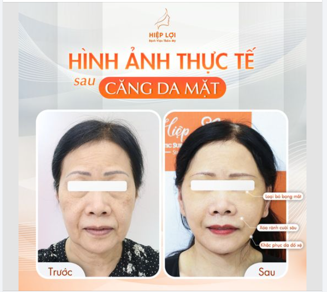 Căng da mặt toàn phần là phương pháp phẫu thuật hiệu quả và làm giảm các nếp nhăn, nếp gấp ở trên vùng mặt cổ; mô mỡ thừa bị lỏng lẻo gây chảy xệ cũng được loại bỏ..