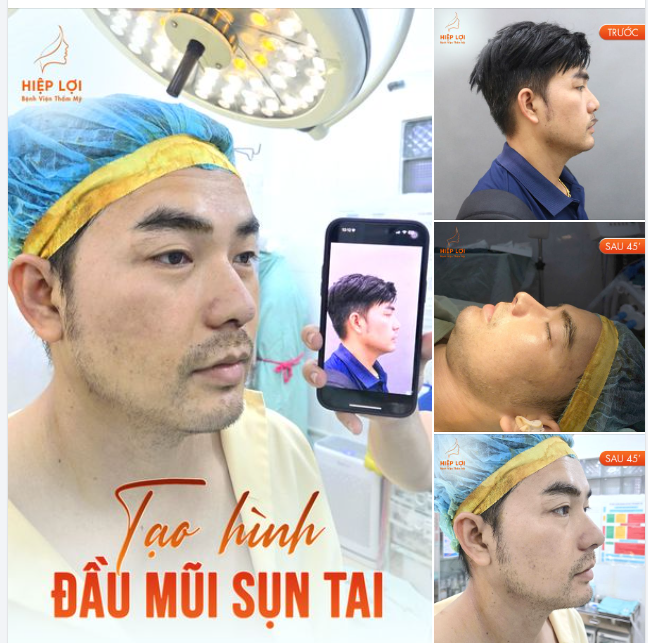 Anh khách đã có dáng mũi cao sẵn, tuy nhiên phần đầu mũi hơi thấp, để tăng sự nam tính và thu hút hơn, anh được bác sĩ Hiệp Lợi tư vấn "Tạo hình đầu mũi bằng sụn tai".
