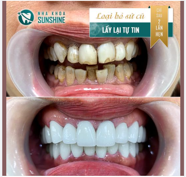 LOẠI BỎ SỨ CŨ - LẤY LẠI SỰ TỰ TIN TẠI SUNSHINE