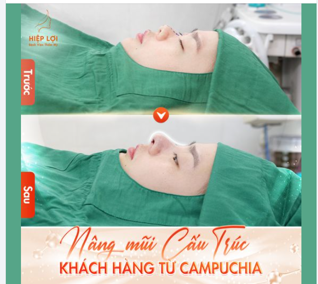 Hình ảnh "nâng mũi" sau 60 phút tại Hiệp Lợi