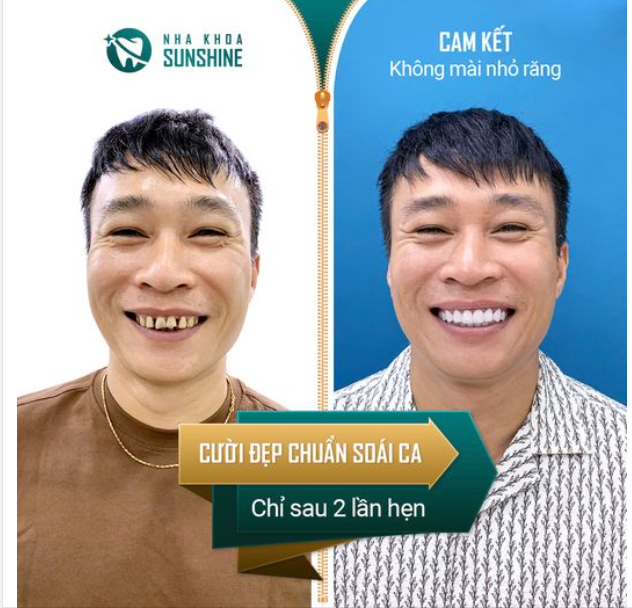 KHÔNG MÀI NHỎ RĂNG, TỰ TIN NỤ CƯỜI ĐẸP CHUẨN SOÁI CA