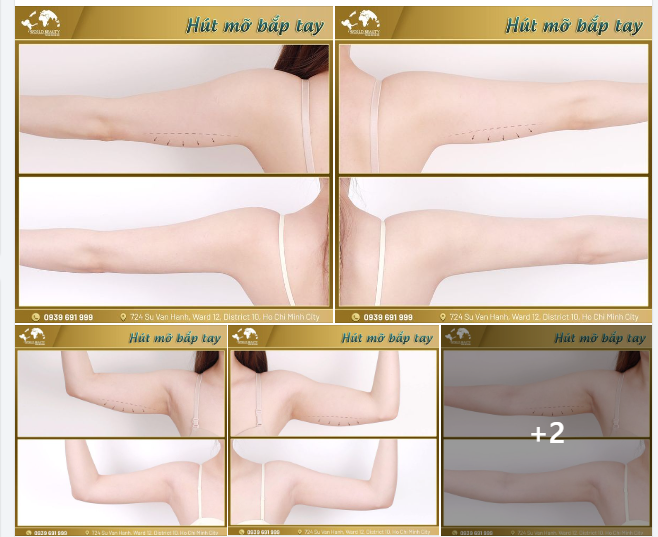 Hút mỡ bắp tay mang lại hiệu quả ra sao và chúng ta có nên lưu ý gì khi đưa ra quyết định thực hiện hút mỡ?