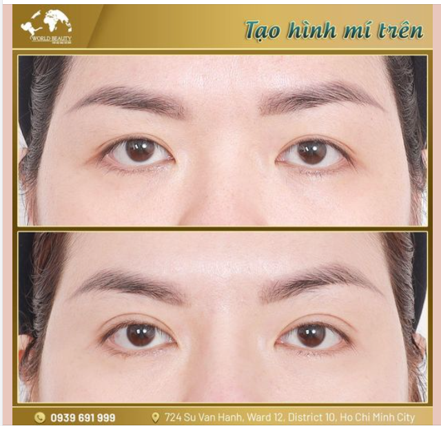 Tạo hình mắt 2 mí sau 3 tháng tại Thế Giới Đẹp giải quyết đồng loạt khuyết điểm cho đôi mắt quý Cô: Nếp mí nhỏ, không đều; Che khuất tầm nhìn, kém tươi tắn.