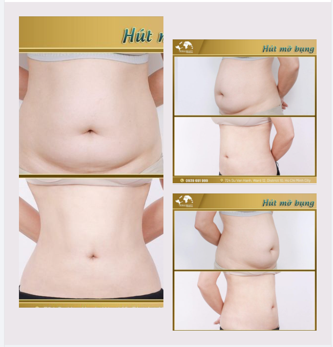 Hút mỡ tạo hình V.òng 2 bí quyết để có ngay E.o thon con kiến bằng công nghệ châu Âu tại Thế Giới Đẹp!