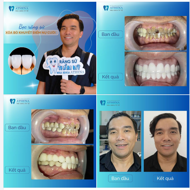 Không còn phải lo lắng về răng xỉn màu, vỡ, hay khấp khểnh.
