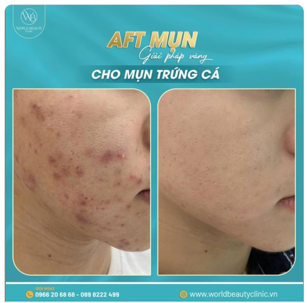AFT mụn - giải pháp vàng cho mụn trứng cá