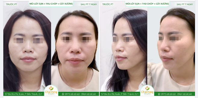 Trước khi đến Charming, dáng mũi của nàng có phần thô và không cân đối, với phần sống mũi hơi thấp, đầu mũi to và không hài hòa với khuôn mặt.