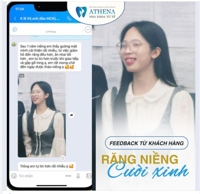 Ngoại hình của bạn thay đổi thế nào sau niềng răng