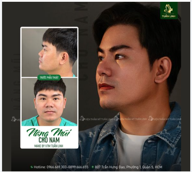 NÂNG MŨI NAM – ĐỊNH HÌNH PHONG CÁCH, TẠO SỰ KHÁC BIỆT!