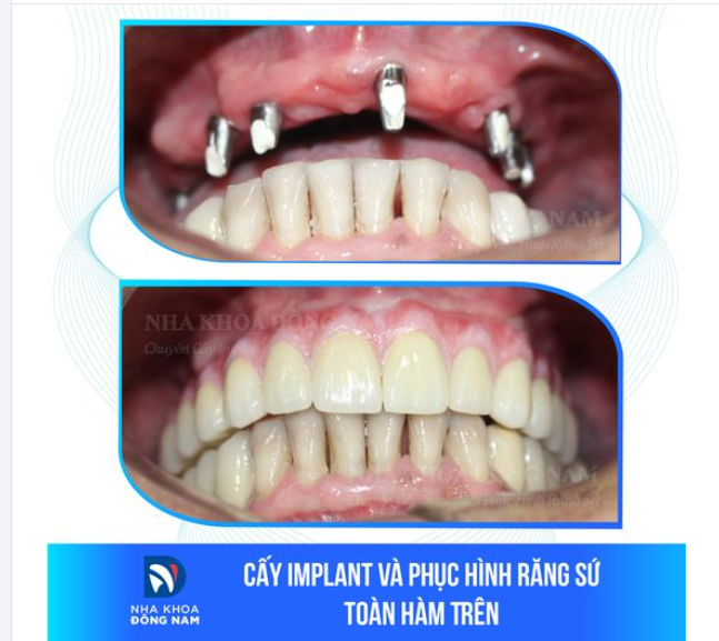 HƠN CẢ MỘT NỤ CƯỜI THẨM MỸ, RĂNG IMPLANT MANG LẠI CUỘC ĐỜI MỚI, TRỌN VẸN!