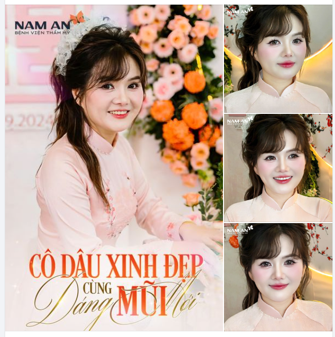 CÔ DÂU XINH ĐẸP SAU NÂNG MŨI