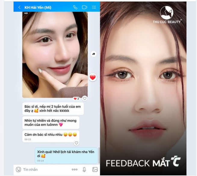 Cắt mí hợp lý. Tối ưu chi phí với ưu đãi cắt mí TC -35% ngay hôm nay