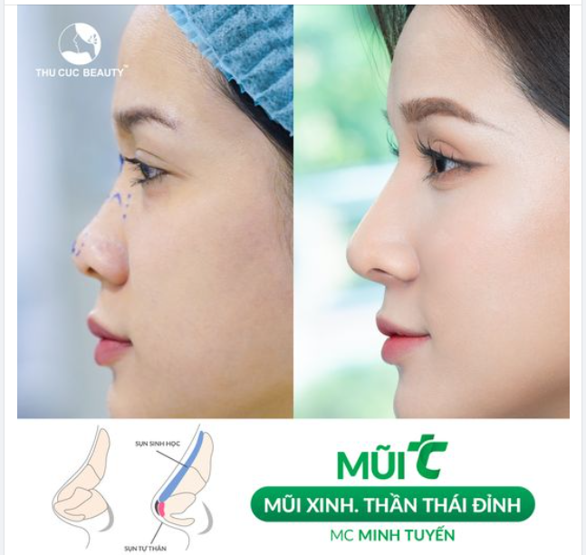 Góc nghiêng, thần thái đỉnh với nâng mũi TC