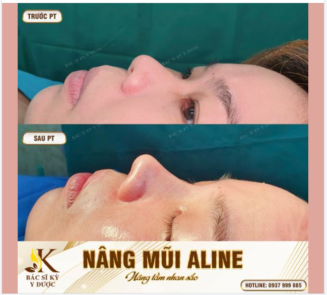 NÂNG MŨI ALINE - ĐẸP NGAY SAU PHẪU THUẬT