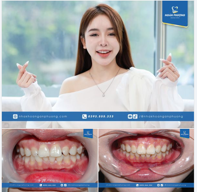 "Răng em quá xấu để làm sứ, có làm cũng không thể đẹp được nên đã chuyển hướng và tìm hiểu niềng răng" - Tiktoker Lê Thủy chia sẻ trong hôm tháo niềng