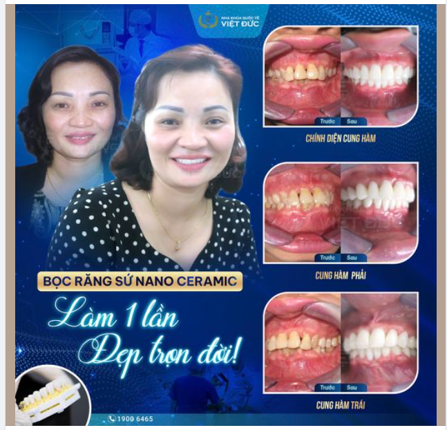 CƯỜI TỰ TIN ĐẸP RẠNG RỠ SAU BỌC RĂNG SỨ THẨM MỸ
