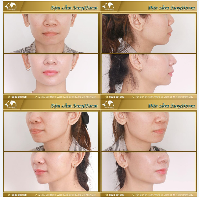Độn cằm Surgiform. kiến tạo gương mặt Vline chuẩn xu hướng