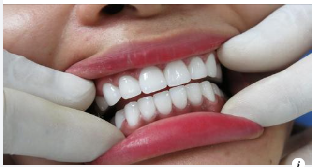 Cảm giác sau khi bọc răng sứ: Những điều bất thường cần lưu ý