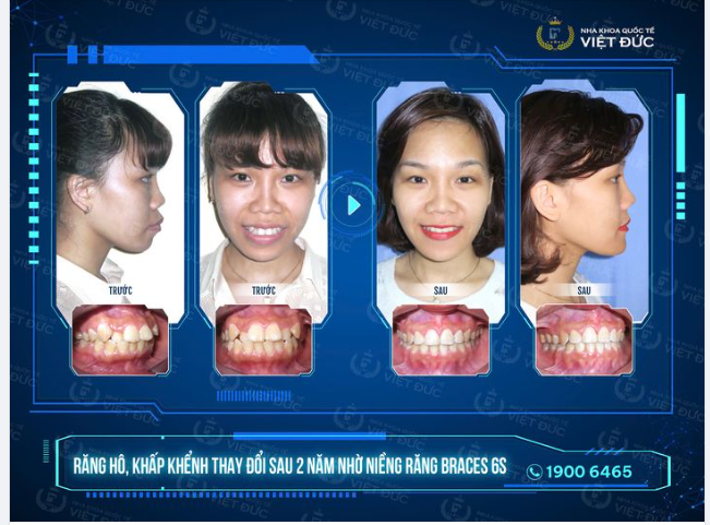 NIỀNG RĂNG BÁC SĨ MẬU - NIỀNG 1 ĐƯỢC 2