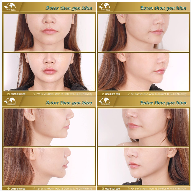 BOTOX THON GỌN HÀM - AN TOÀN VỚI GIẢI PHÁP LÀM ĐẸP KHÔNG XÂM LẤN