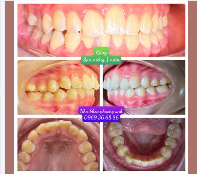 Niềng Răng Bằng Invisalign So Với Niềng Răng Truyền Thống