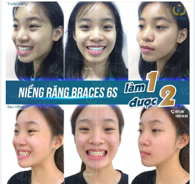 MỪNG NGÀY THÁO NIỀNG: KHÁCH HÀNG ĐINH HÀ THẢO MY