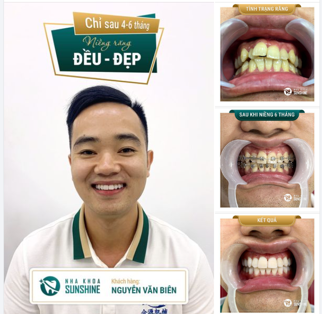 NIỀNG RĂNG MẮC CÀI KIM LOẠI - AN TOÀN MÀ HIỆU QUẢ