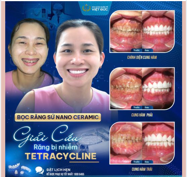 GIẢI CỨU RĂNG NHIỄM TETRACYCLINE CHỈ SAU 48H