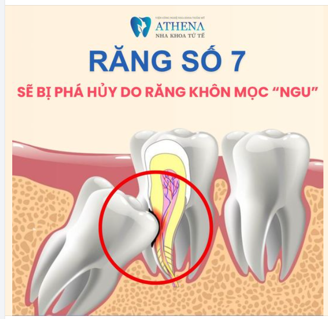 Răng khôn, hay còn gọi là răng số 8, thường mọc ở phía sau cùng của hàm và có thể gây ra một số vấn đề nếu không có đủ không gian trong miệng