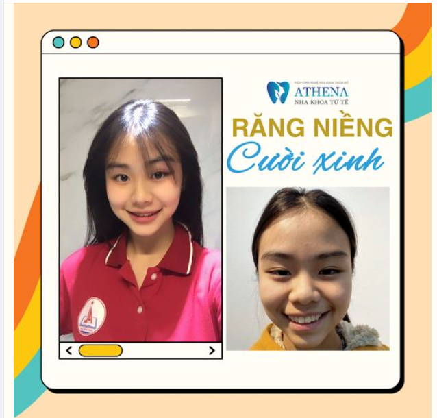 Dậy thì thành công nhờ niềng răng