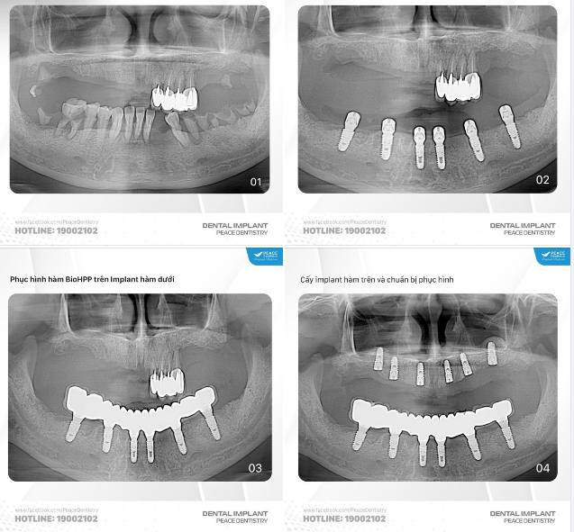 CA LÂM SÀNG ALL-ON-6 IMPLANT HAI HÀM VÀ LỢI ÍCH TRỒNG IMPLANT TỪ SỚM