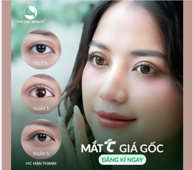 Loại bỏ tình trạng nhiều nếp mí, mắt lờ đờ thiếu sức sống