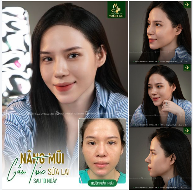 Nâng mũi cấu trúc sửa lại - Chạm tới vẻ đẹp hoàn hảo!!