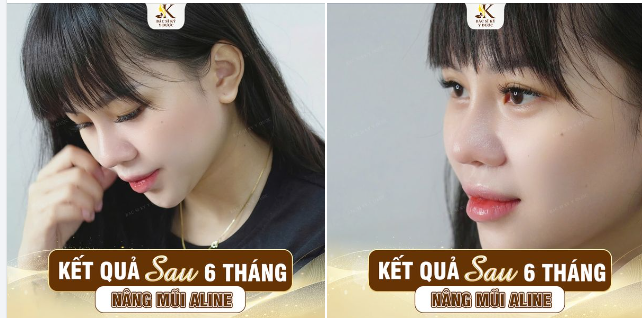 TỰ TIN RẠNG RỠ SAU 6 THÁNG NÂNG MŨI ALINE