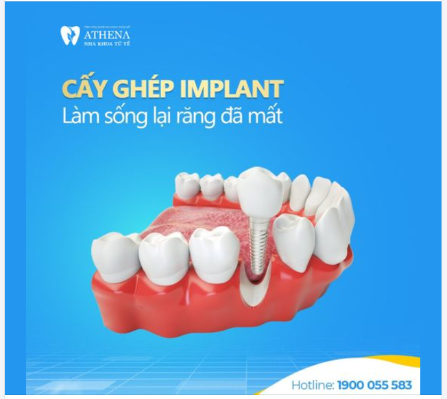 CẤY GHÉP IMPLANT - GIẢI PHÁP LÀM SỐNG LẠI RĂNG ĐÃ MẤT